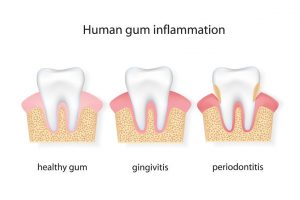 gum disease prevention